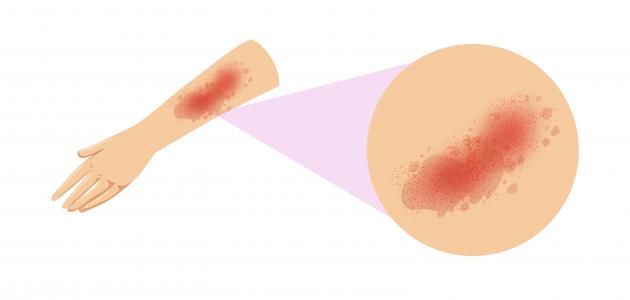 أنواع الطفح الجلدي