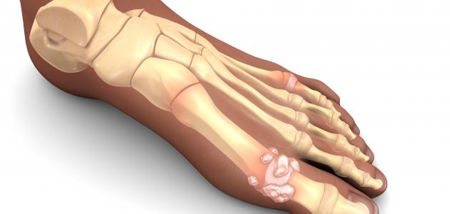 أهم أمراض الجهاز الهيكلي أهم أمراض الجهاز الهيكلي