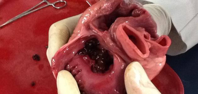 أين يقع الشريان التاجي أين يقع الشريان التاجي