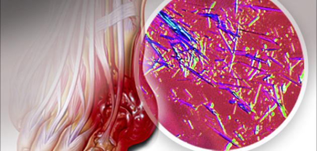 ارتفاع اليوريك أسيد ارتفاع اليوريك أسيد