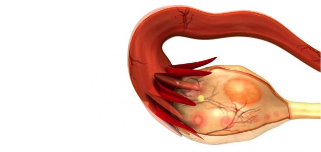 اسباب تكيس المبايض وعلاجه اسباب تكيس المبايض وعلاجه