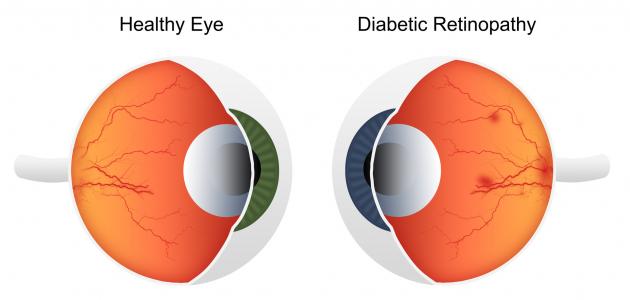 اعتلال الشبكية اعتلال الشبكية