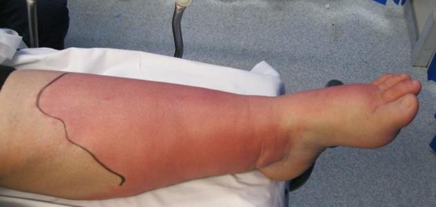 الالتهاب البكتيري في الجلد الالتهاب البكتيري في الجلد