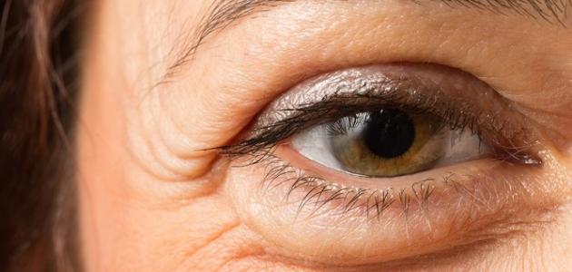 الانتفاخ تحت العين