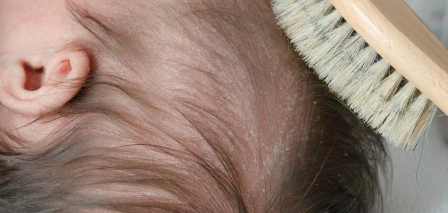 التخلص من قشرة رأس الرضيع التخلص من قشرة رأس الرضيع