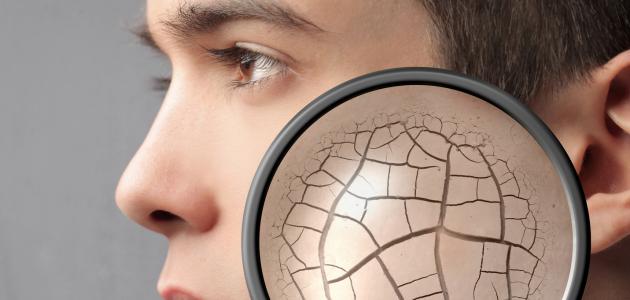 التشققات الجلدية و علاجها التشققات الجلدية و علاجها