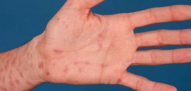 التغيرات النسيجية في مرض الزهري التغيرات النسيجية في مرض الزهري