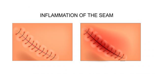 التهاب الجرح بعد الخياطة التهاب الجرح بعد الخياطة