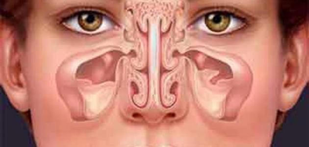 التهاب الجيوب الأنفية التهاب الجيوب الأنفية