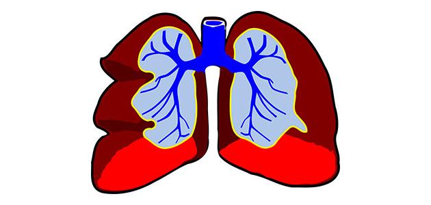 التهاب الشعب الهوائية