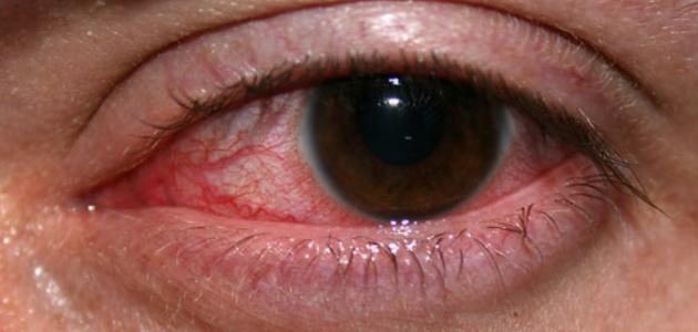 التهاب القرنية التهاب القرنية