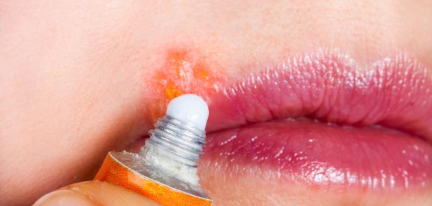 التهاب حول الفم التهاب حول الفم