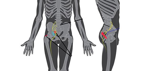 التهاب عرق النسا عند الرجال