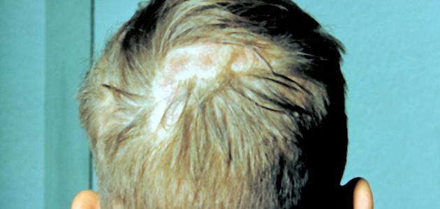 التهاب فروة الرأس التهاب فروة الرأس