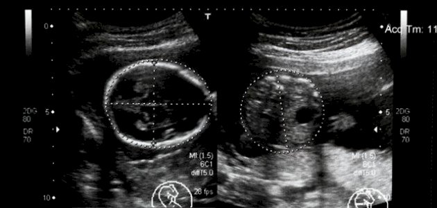 الجنين في الأسبوع السادس