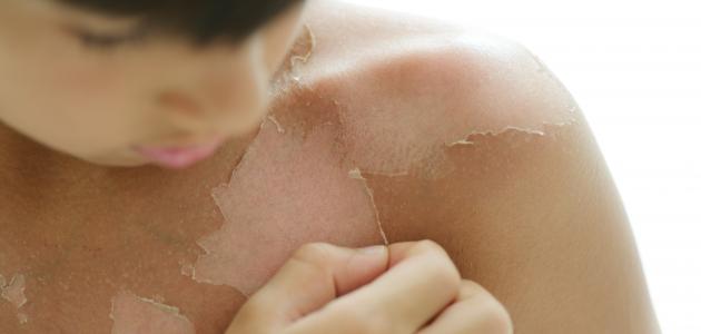 الحروق من الدرجة الأولى