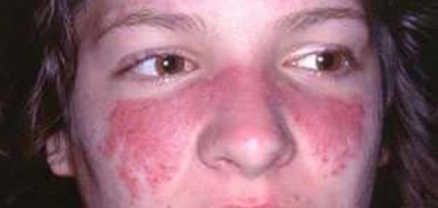 الذئبة الحمراء والجهاز الهضمي والدم