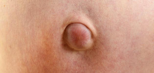 الفتق السري والجنب السري - فيديو