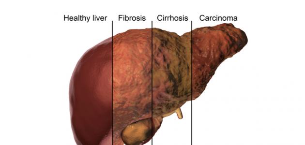 الفرق بين تشمع الكبد وتليف الكبد الفرق بين تشمع الكبد وتليف الكبد