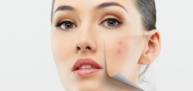 الليمون لعلاج حب الشباب الليمون لعلاج حب الشباب