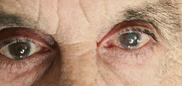 الماء الأبيض في العين - فيديو الماء الأبيض في العين - فيديو