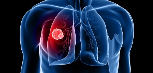 المرحلة الاخيرة لسرطان الرئة المرحلة الاخيرة لسرطان الرئة