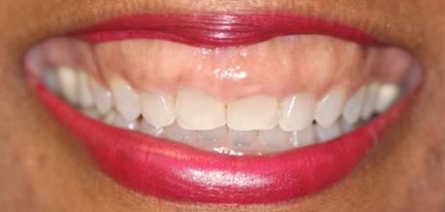 انتفاخ اللثة انتفاخ اللثة