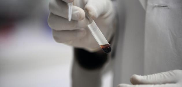 تحليل الزلال تحليل الزلال