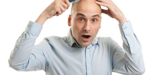 تساقط الشعر الوراثي تساقط الشعر الوراثي