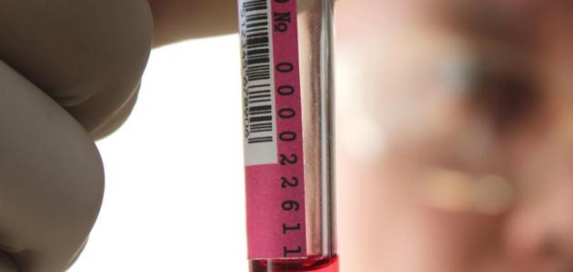 تشخيص ارتفاع ضغط الدم تشخيص ارتفاع ضغط الدم