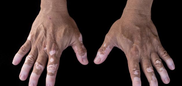 تشخيص البهاق تشخيص البهاق