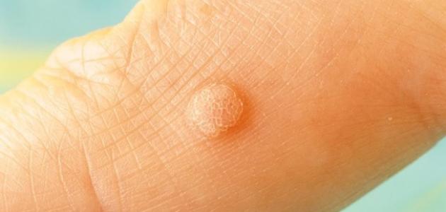 تعريف بمرض عين السمكة تعريف بمرض عين السمكة