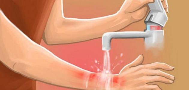 حروق الدرجة الثالثة حروق الدرجة الثالثة