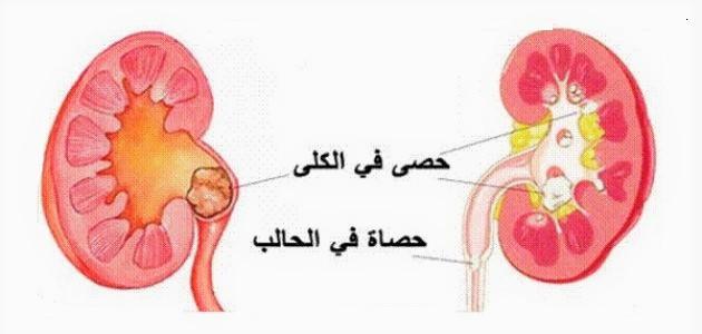 حصى الكلى أسبابها وعلاجها حصى الكلى أسبابها وعلاجها