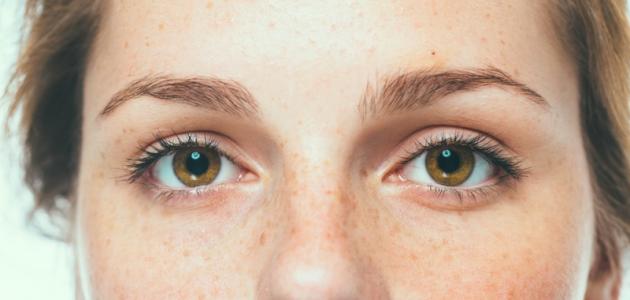 خلطة لإزالة النمش من الوجه