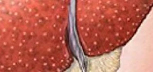 دهون الكبد وتضخم الطحال دهون الكبد وتضخم الطحال