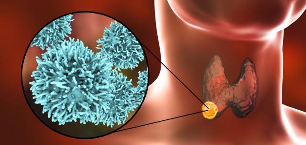 سرطان الغدة الدرقية سرطان الغدة الدرقية