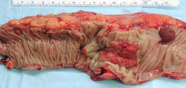 شكل ورم السرطان شكل ورم السرطان