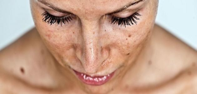 طرق تفتيح البشرة من حروق الشمس طرق تفتيح البشرة من حروق الشمس