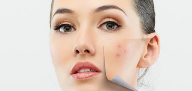 طريقة إخفاء حب الشباب بالمكياج طريقة إخفاء حب الشباب بالمكياج