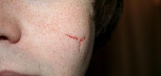 طريقة إزالة الندوب من الوجه طريقة إزالة الندوب من الوجه