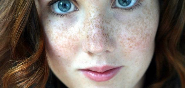 طريقة إزالة النمش من الوجه طريقة إزالة النمش من الوجه