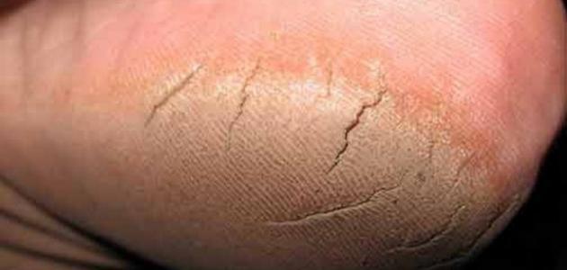 طريقة إزالة تشققات القدمين طريقة إزالة تشققات القدمين