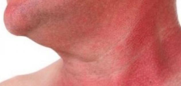 طريقة إزالة حروق الشمس من الوجه طريقة إزالة حروق الشمس من الوجه