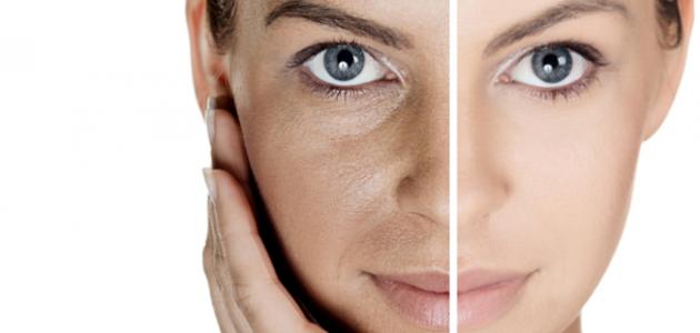 طريقة علاج كلف الوجه طريقة علاج كلف الوجه