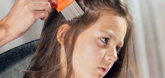 طريقة لإزالة القمل بسرعة طريقة لإزالة القمل بسرعة