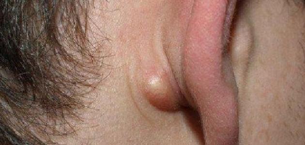 ظهور غدة خلف الأذن ظهور غدة خلف الأذن