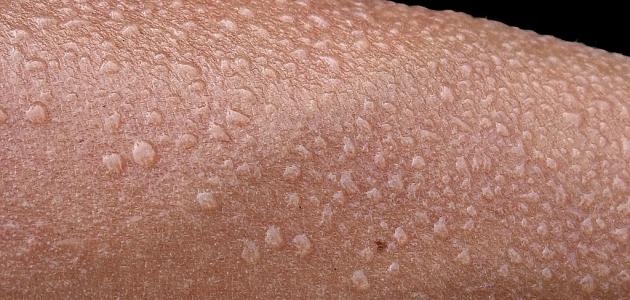 عدد الغدد العرقية في جسم الإنسان