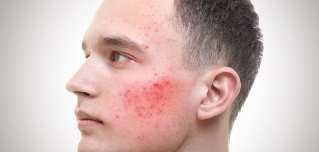 علاج آثار حب الشباب للبشرة الدهنية علاج آثار حب الشباب للبشرة الدهنية