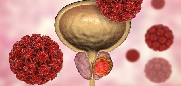 علاج التهاب البروستاتا